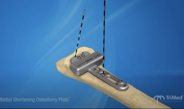 Radial Osteotomy Plate