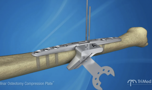 Ulnar Osteotomy Plate